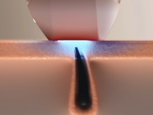 Close-up cross-sectional illustration of IPL hair removal, with a pulse of light targeting the hair follicle beneath the skin to help reduce future hair growth.
